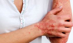 پسوریازیس چگونه شکل میگیرد؟ بررسی ۳ عامل کلیدی