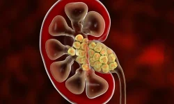 راهکارهایی برای پیشگیری از نارسایی و سنگ کلیه