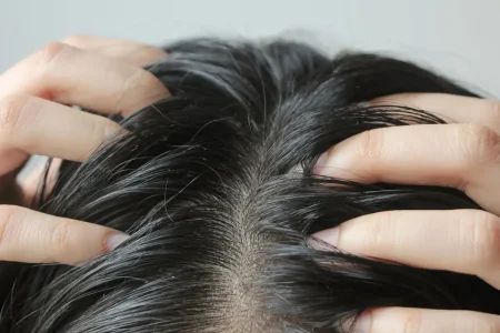 کدام کمبود تغذیه‌ای باعث خارش پوست سر می‌شود؟