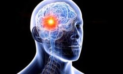 آشنایی با شایعترین علت خونریزی مغزی
