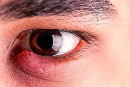 هشدار درباره یک عارضه شایع چشمی؛ گلمژه را جدی بگیرید!